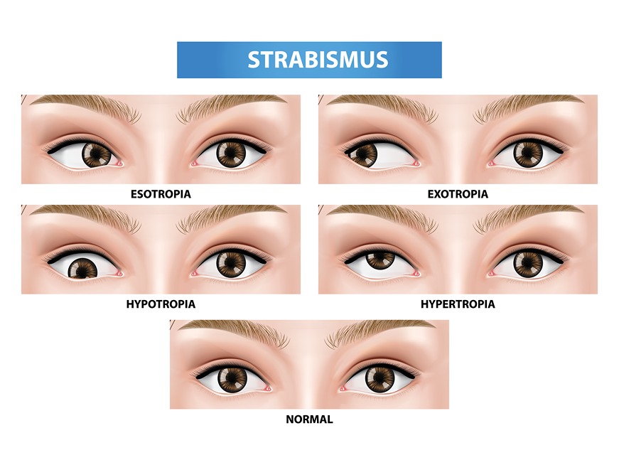 Strabismus